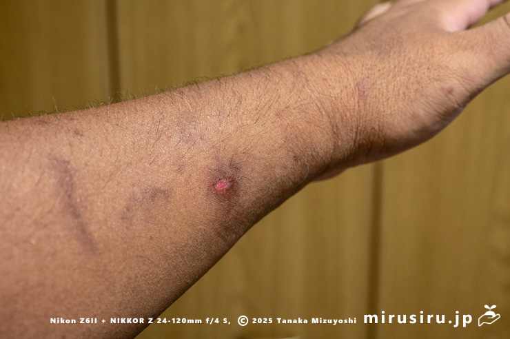 イチジクの剪定後に発症したかぶれ（黒っぽく変色している部分すべて）や爛れ　2025/06/24